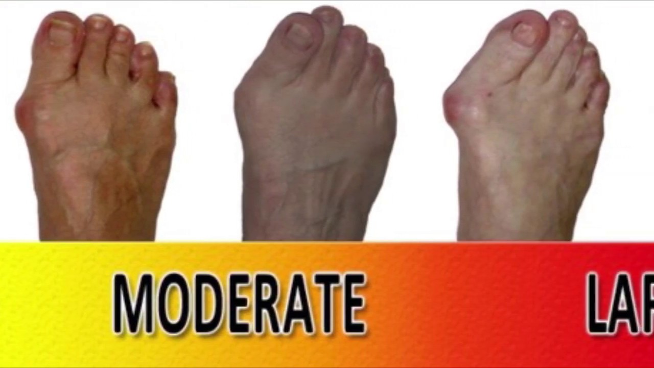 What can I do about my bunions?