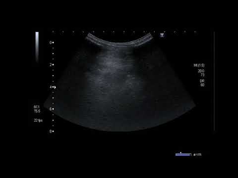 [Mini] Intra-abdominal Abscess