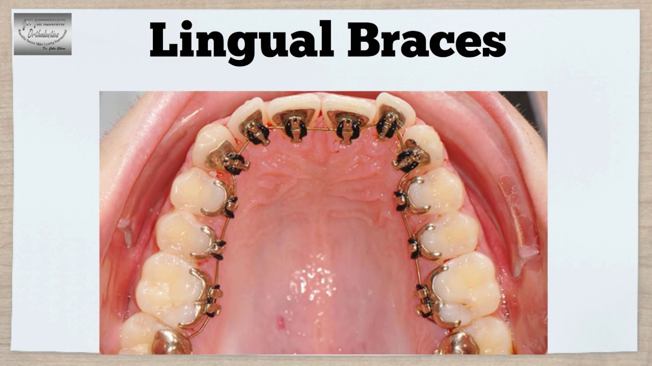 1st Impressions Orthodontics Offers Denver Orthodontics, Braces & Invisalign Treatment! YouTube