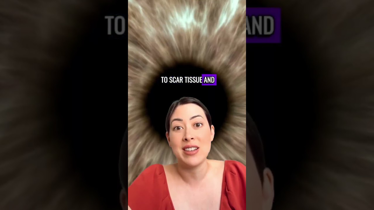 When is a corneal transplant necessary for keratoconus?