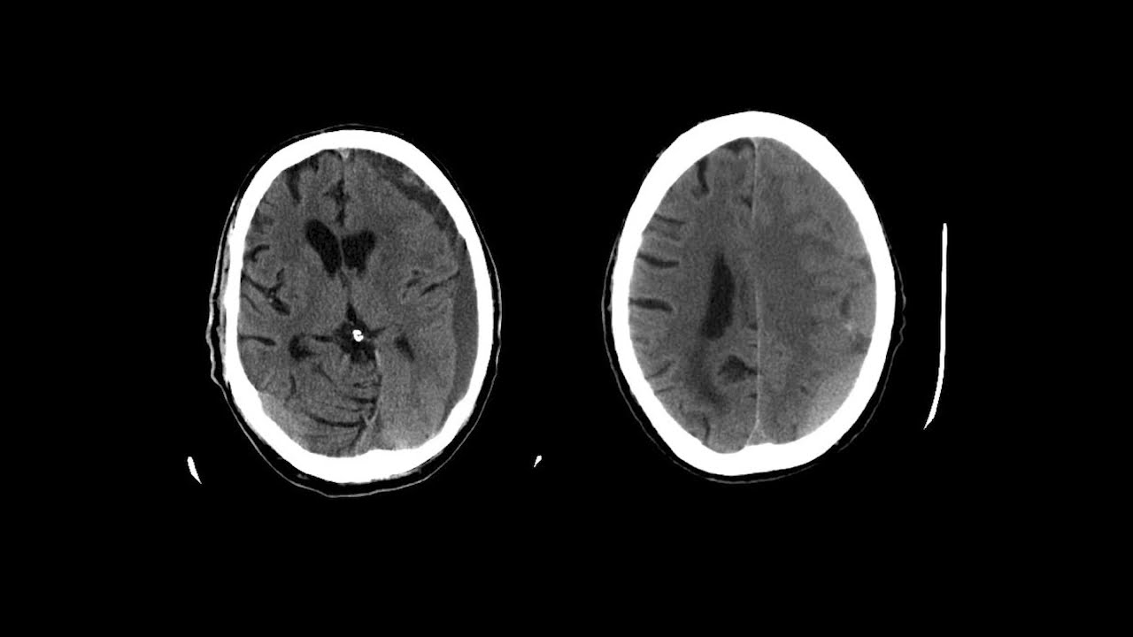 Imaging In Head Trauma YouTube Imaging In Head Trauma YouTube