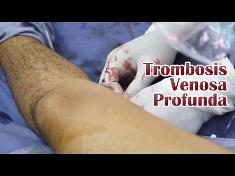 Vídeo: Trombectomía: Tipos De Cirugía, Indicaciones, Resultados