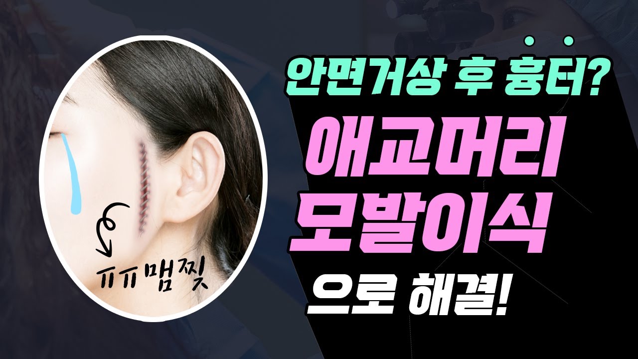 안면거상 후 흉터? 애교머리 모발이식으로 해결!
