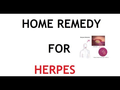 herpes en niños 5 Home Remedy for Herpes