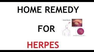 5 Home Remedy for Herpes