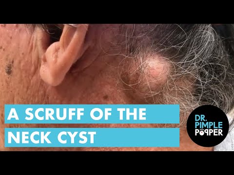 Scruff of the Neck Epidermoid Cyst