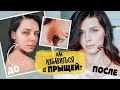 Как избавиться от ПРЫЩЕЙ? Мой УХОД. Тренировки и Высыпания.