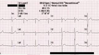 Electrocardiogram | Wikipedia audio article