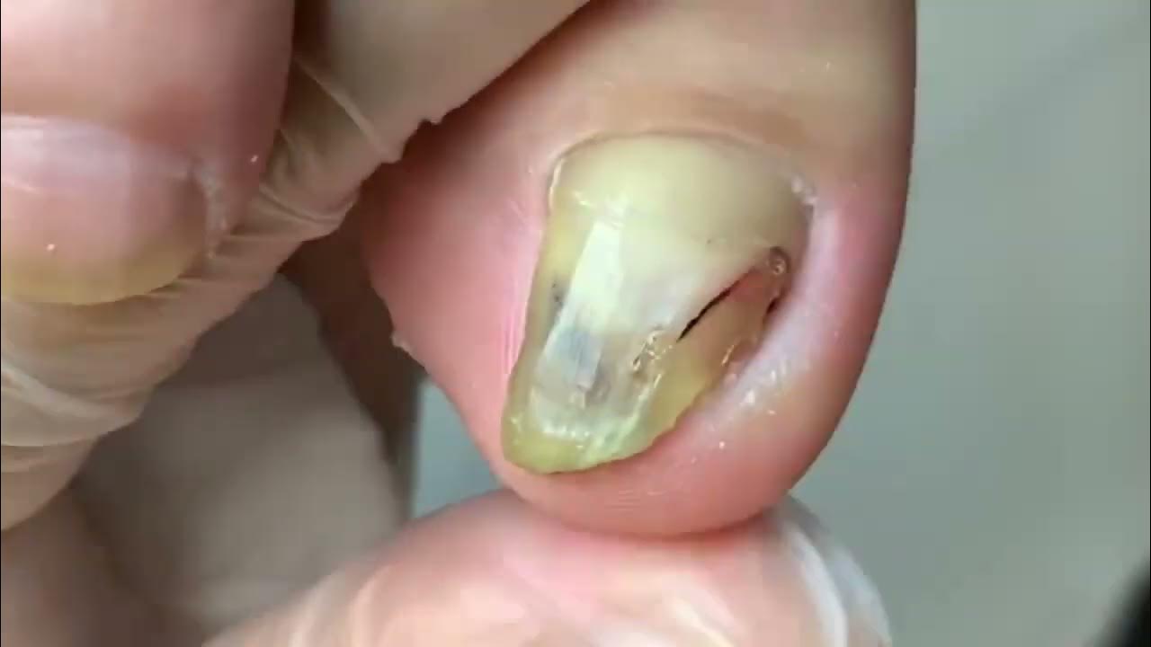Parrot fungus toenail cutting and treatment He Pedicure YouTube