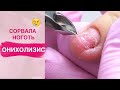 Сорвала ноготь 😱 Убираем ОНИХОЛИЗИС ногтей на руках