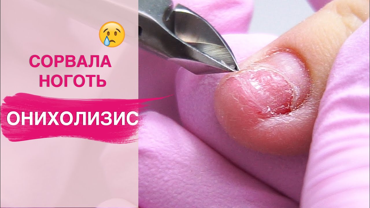 Сорвала ноготь 😱 Убираем ОНИХОЛИЗИС ногтей на руках - YouTube
