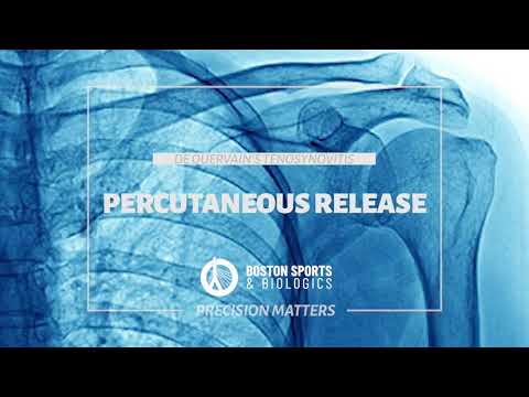 De Quervain’s Tenosynovitis: Ultrasound-Guided Release vs. Surgery