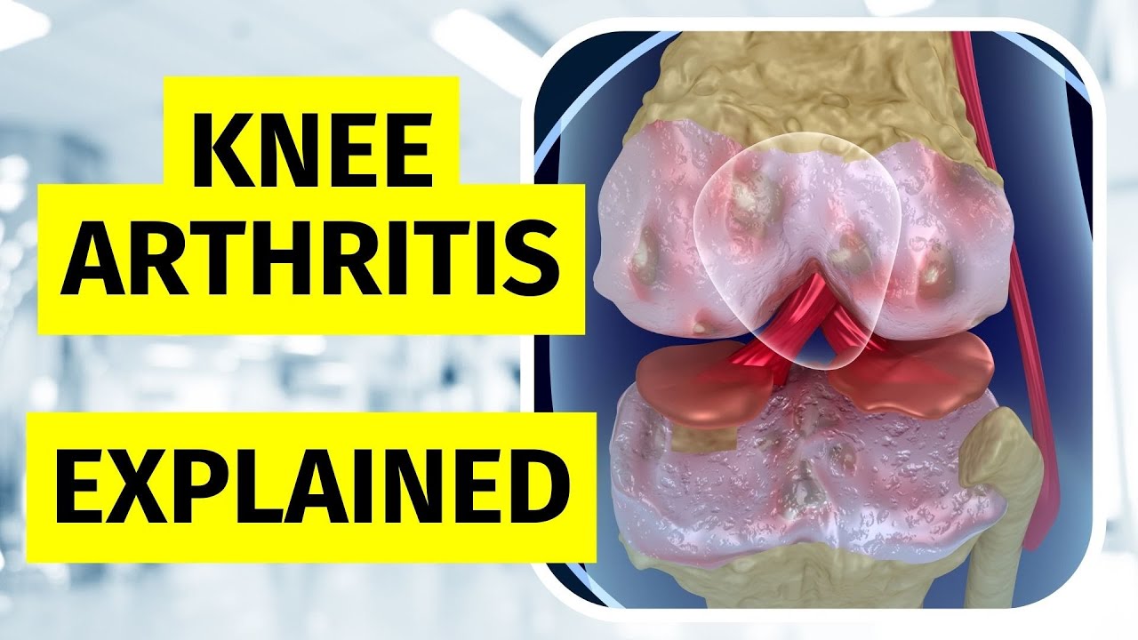 Knee Arthritis Explained Treatments and Injections YouTube