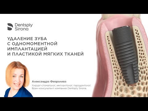 Удаление зуба с одномоментной имплантацией и пластикой мягких тканей