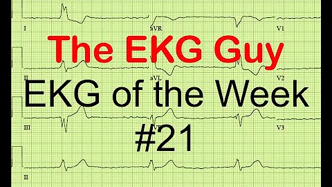 EKG/ECG of the Week #21 | The EKG Guy - www.ekg.md