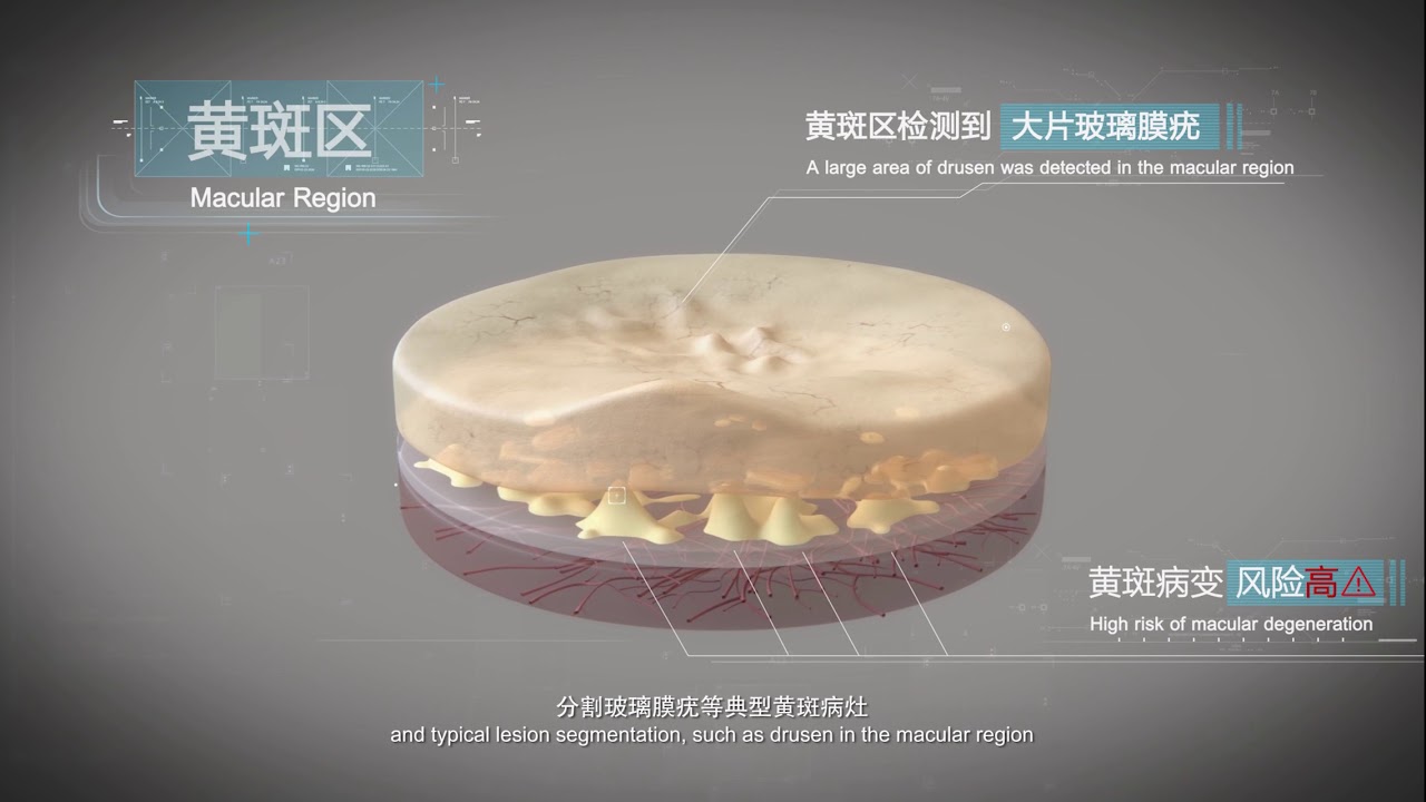 Baidu AI Fundus Camera