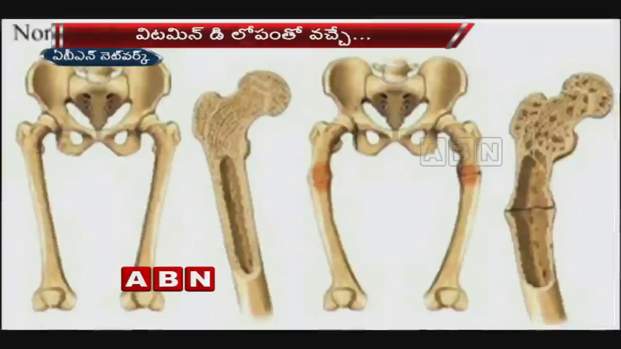 Vitamin D deficiency increases risk of cancer YouTube