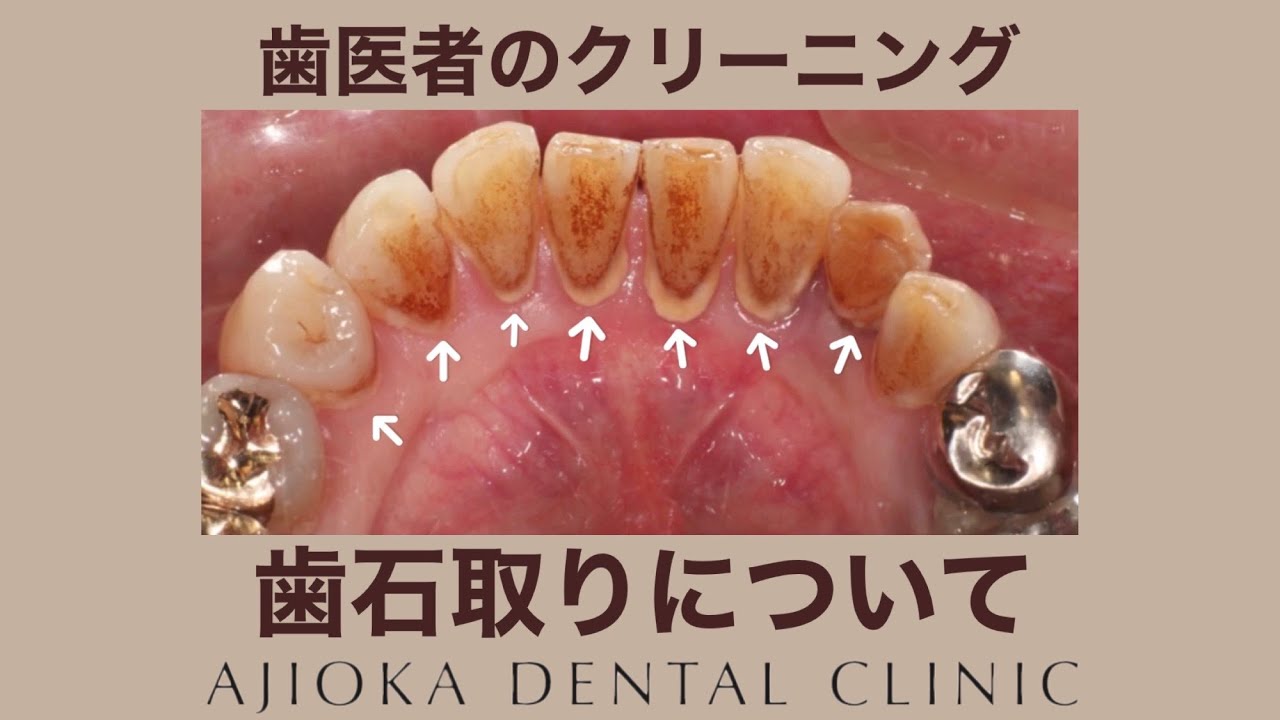 歯石 の 取り 方 歯医者