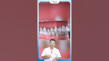 Răng Niềng Có Nên Dùng Máy Tăm Nước Không | Nha Khoa Minh Châu