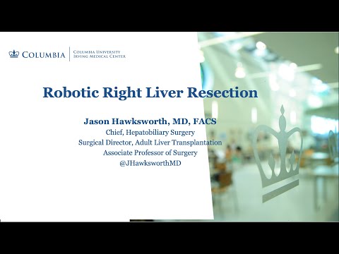Video thumbnail for Robotic Right Liver Resection
