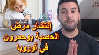هام لمن يعيش في أوروبا - إنتشار مرض الحصبة بوحمرون وسط الأطفال في أوروبا و منظمة الصحة العالمية تحذر هام لمن يعيش في أوروبا - إنتشار مرض الحصبة بوحمرون وسط الأطفال في أوروبا و منظمة الصحة العالمية تحذر