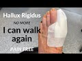 Hallux Rigidus No More