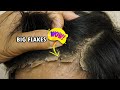 Huge Psoriasis Flakes Scratching Satisfying (Dandruff Removal) #432