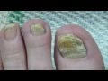 Toe Nail Fungus Cure 30 Months Progress