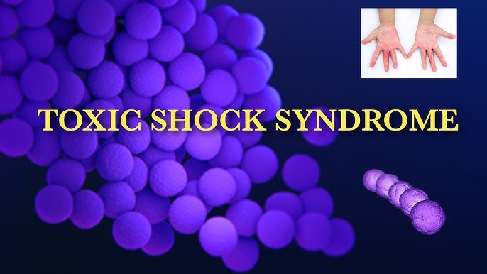 Streptococcal toxic shock syndrome revealed phlegmasia cerulea dolens of  the arm - The Lancet Infectious Diseases