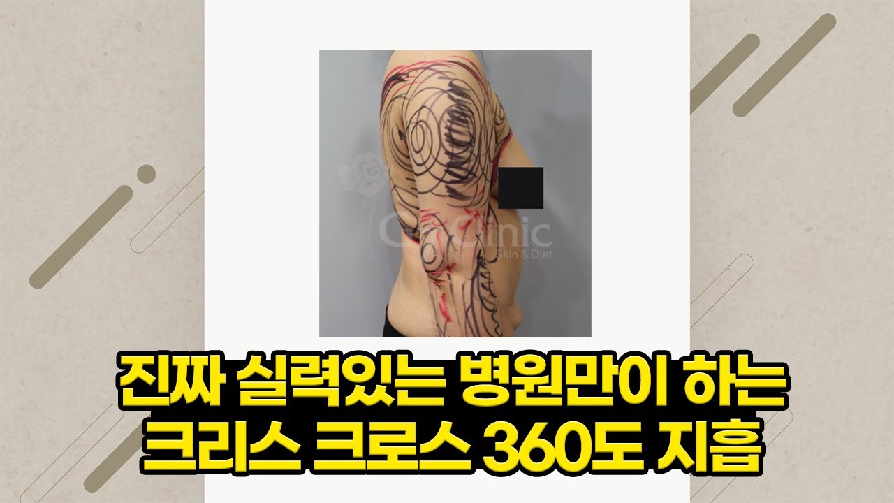 Criss- cross 360도 지방흡입 | 영상으로 보는 블로그 | 닥터 조의 지방흡입에 대한 생각들