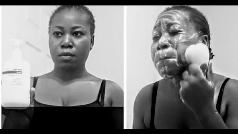 HOW TO: GETTING RID OF MY ACNE / PIMPLES