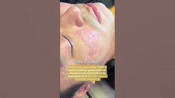 TCA Cross for Acne Scars