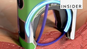 Device Creates Precise Surgical Sutures