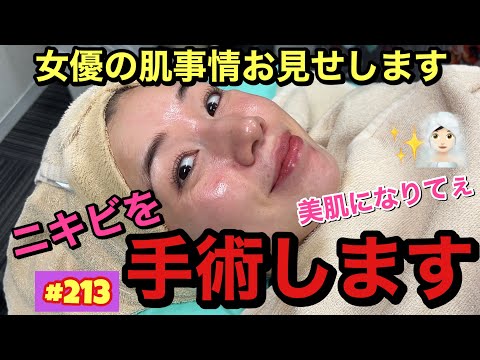 ニキビを手術します👩‍⚕️ニキビできまくった女優の肌事情を初公開して晒します