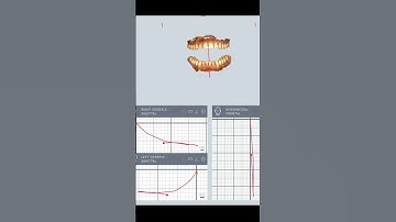 Digital jaw motion recording the next frontier of digital planning #digitaldentistry
