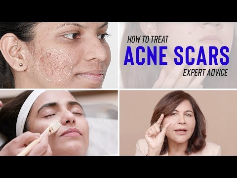 Treatments for ACNE SCARS | Dr. Bindu&rsquo;s Expert Advice