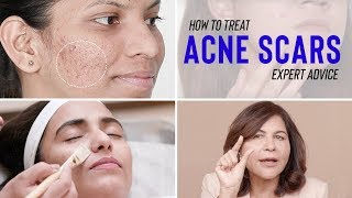 Treatments for ACNE SCARS | Dr. Bindu's Expert Advice screenshot 1