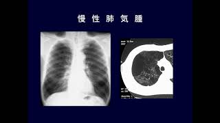 肺化膿症と膿胸