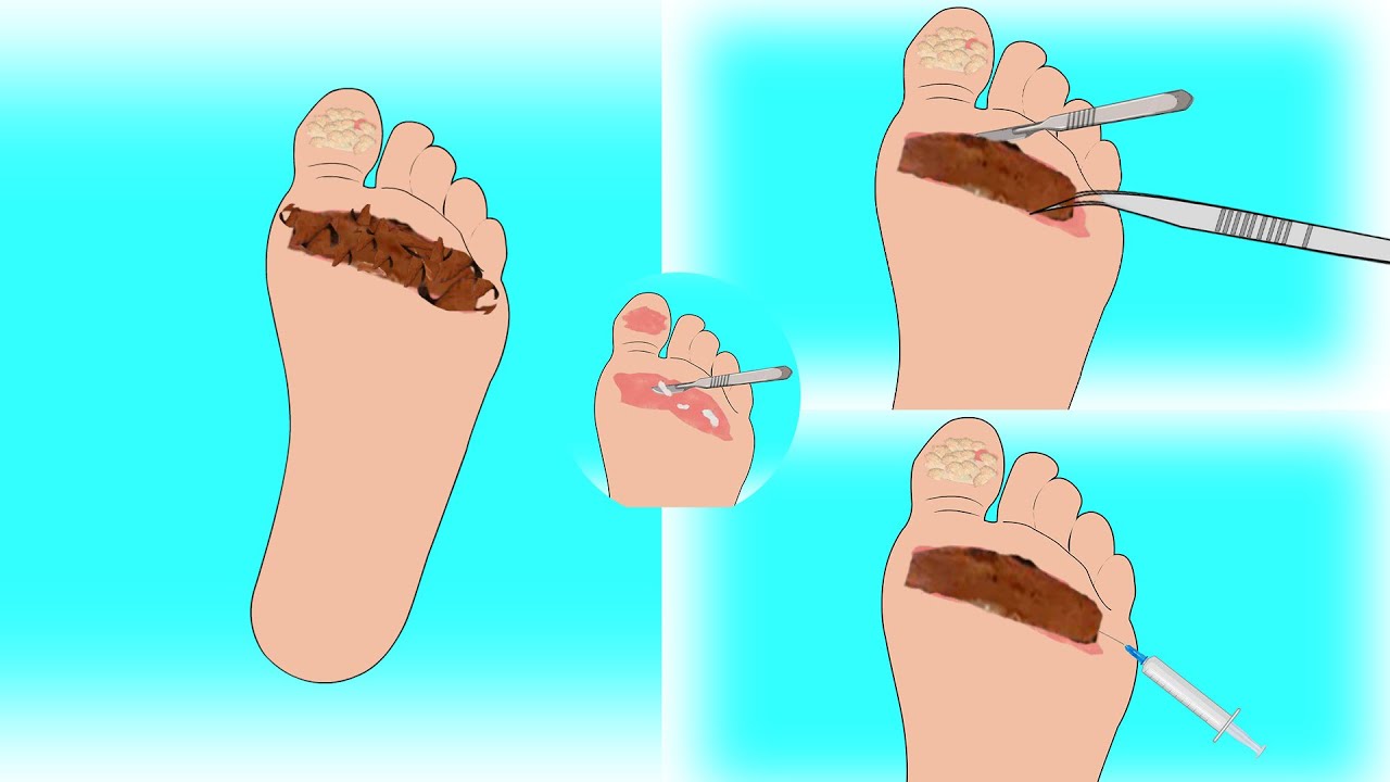 ASMR Treatment Remove Foot Wart Animation Foot Plantar Corn Remove