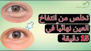 انتفاخ تحت العين اسبابه وعلاجه｜تغذية علاجية ?️??️ نتائج ستبهرك