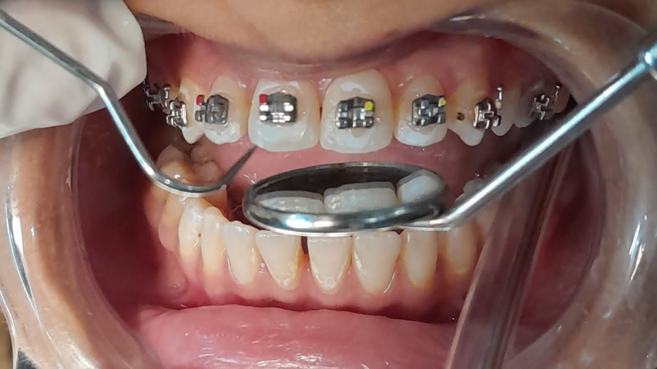 Fastest Dental Braces Process (step by step) How dental braces work