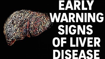"The Hidden Signs Your Liver Is in Trouble – Don’t Ignore These!"