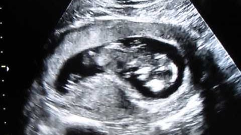 First Ultrasound Part 1- First Look and Heartbeat