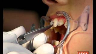 Braces Part 3: How the new braces are inserted screenshot 2