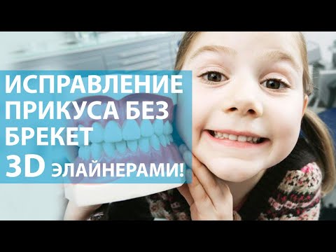 Исправление прикуса у детей и подростков без брекетов 3D элайнерами