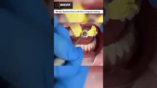 Mid Line Diastema Closure With Direct Composite Buildup