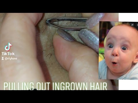 Underarm Ingrown Hair Removal -  satisfying to watch