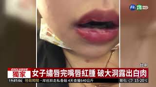疑免疫力下降女繡唇誘發皰疹感染!| 華視新聞20190116