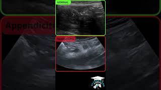 How to Diagnose Appendicitis with Ultrasound: Identifying Normal and Pathological Appendix