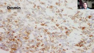Tip-40;Rhabdomyosarcoma of the Breast